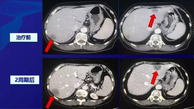 肠癌肝转移同时性和异时性,邢宝才治疗肠癌肝转移成功病例