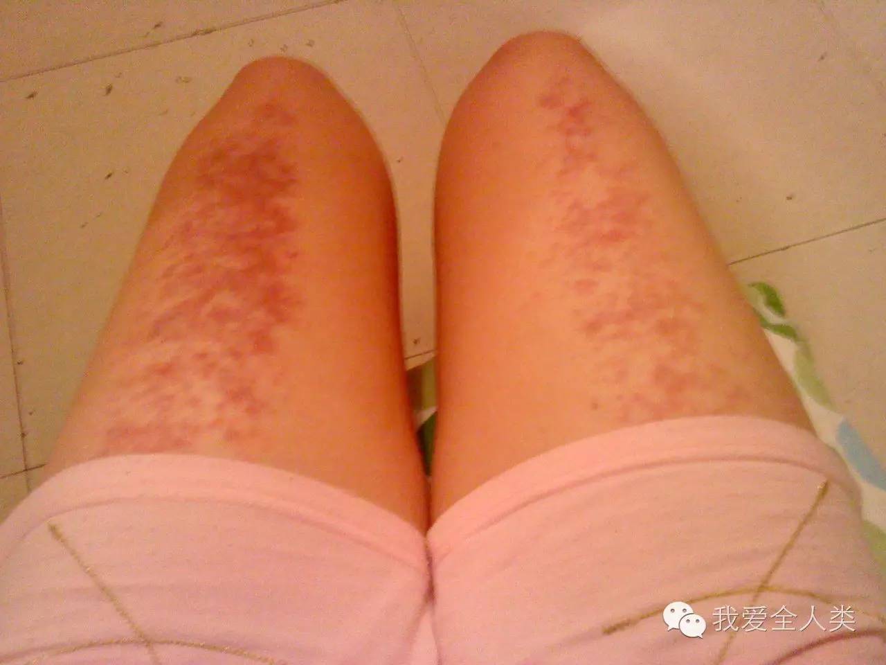 别再折腾拔罐了，中国还有其它好东西呢