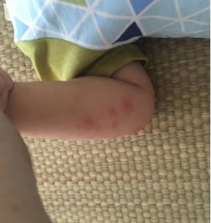 儿童湿疹引起皮肤溃烂怎么办,婴儿皮肤湿疹怎么处理