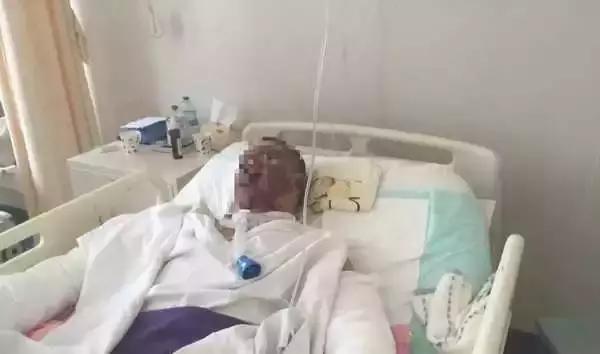 五佳|100公里外飘来的氢气球把父子俩烧得面目乌黑