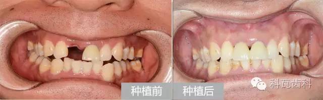 缺牙后果,缺牙修复全过程3d演示