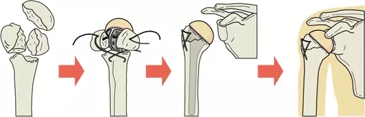 医生手术没做好留下后遗症,医生手术完病没好