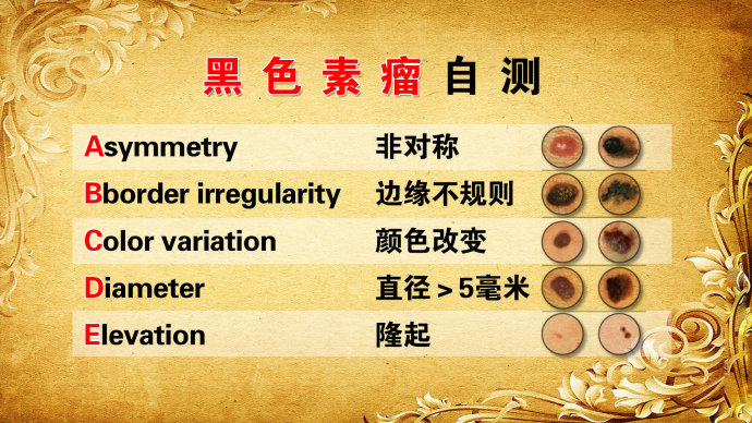 孙红雷曾说：得了黑痣赶紧点，千万别以为是好运和性感！真的吗？