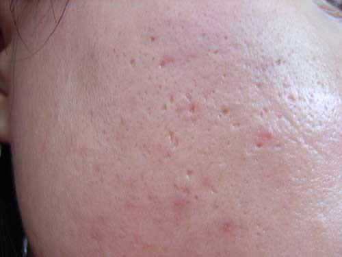 痘印痘坑怎么去除最有效的方法,男士痘坑痘印修复的最佳方法