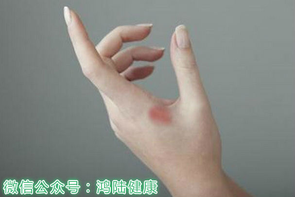 专治烧烫伤奇效方,烧烫伤特效药大全一览表