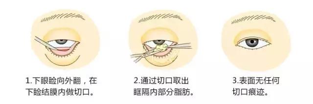 眼袋和卧蚕和泪沟的区别,你能不能搞清楚自己需要的是什么