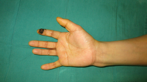 孙红雷曾说：得了黑痣赶紧点，千万别以为是好运和性感！真的吗？