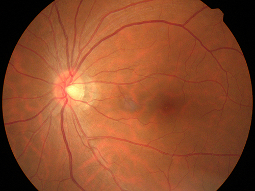 高度近视的孕妇可以顺产吗,视网膜脱离病史妈妈可以顺产吗