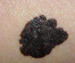 孙红雷曾说：得了黑痣赶紧点，千万别以为是好运和性感！真的吗？