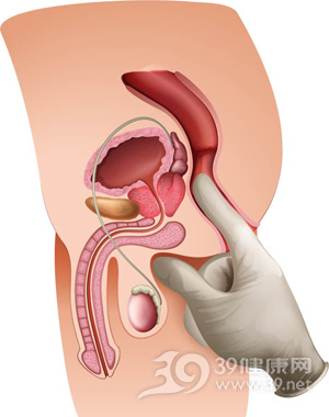 大肠癌怎么认定为早期,大肠癌的早期十大症状