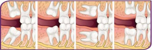 智齿牙龈肿痛怎么办立刻止疼,智齿牙龈肿痛怎么办吃什么药