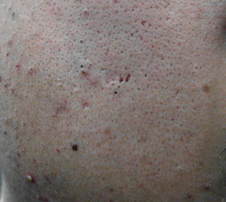 毛孔粗大真的没有办法可以救吗,毛孔粗大就不能再收缩了吗