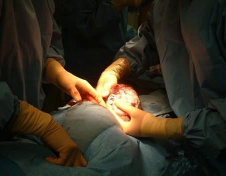 剖腹产必须知道的9个方面,剖腹产怎么才能轻松点