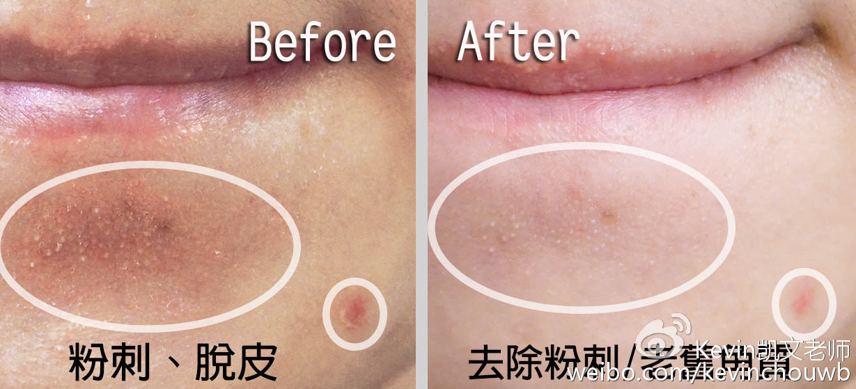 痘痘黑头粉刺用什么化妆品,痘痘粉刺黑头用什么化妆品