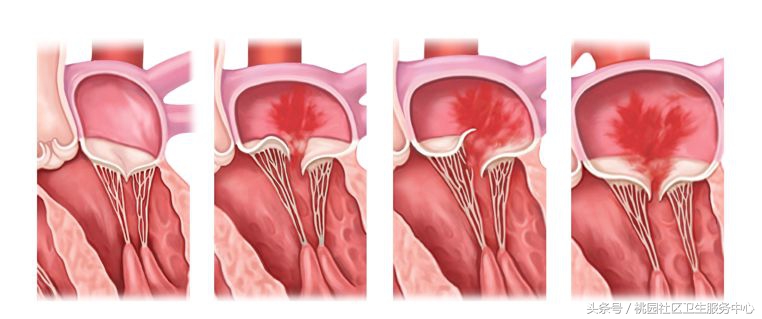心室支架说明书,这份通俗易懂的心室说明书请收好