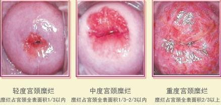 帮帮忙！宫颈糜烂患者还能用卫生棉条吗？