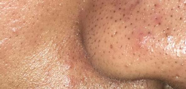 毛孔粗大真的没有办法可以救吗,毛孔粗大就不能再收缩了吗