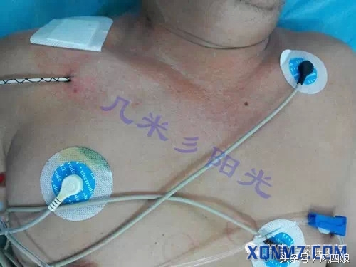 锁骨下静脉穿刺出血不止,锁骨下静脉穿刺部位肿胀怎么办