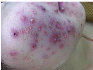 脸上突然冒出一堆大痘痘什么原因,脖子后面脸上都长了很多红色痘痘