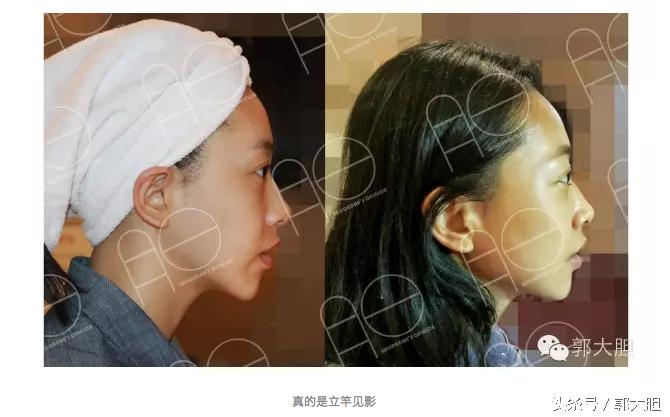 当你以为抗老还要靠超声刀的时候，我去打了更牛X的热拉提