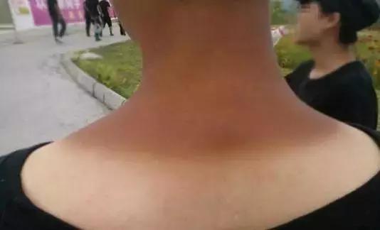 军训皮肤晒伤起皮了怎么办,军训皮肤晒伤怎么补救最快