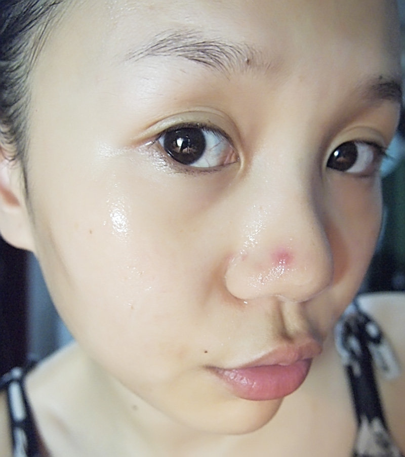 如何在一周内祛痘最有效的方法,健康祛痘的最佳方法