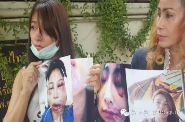 整容失败有多可怕,整容失败多可怕