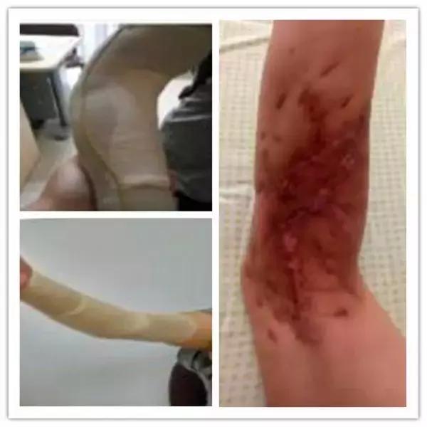 这只被车子压得“稀烂”的手是如何被修补起来的