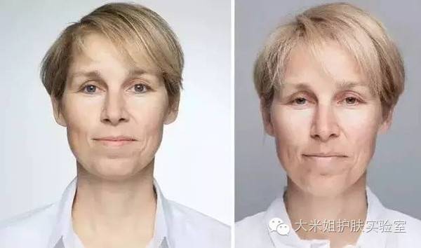 怀孕变老如何预防,孕妇妊娠斑护肤