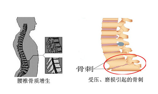 腰椎骨质增生如何缓解,腰椎骨质增生的最好治疗办法