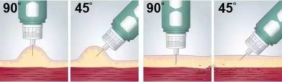 胰岛素注射笔针头选择,胰岛素针头执行标准