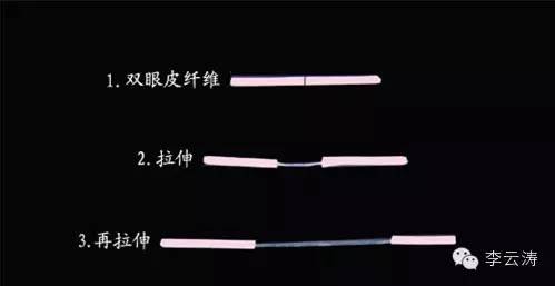 双眼皮18天消肿方法,贴双眼皮教程三眼皮