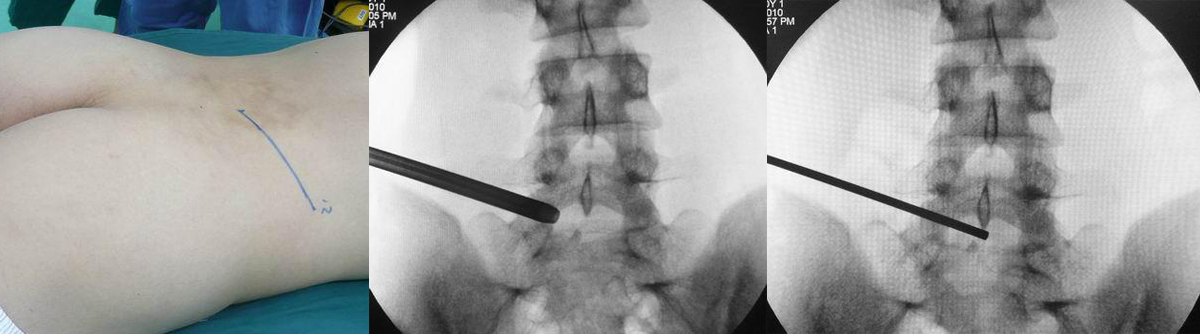 微创手术治疗腰椎间盘突出成功率,目前最热门腰椎微创技术椎间孔镜