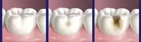 蛀牙怎样才能控制住不再有蛀牙,蛀牙不严重用什么药