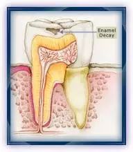 蛀牙怎样才能控制住不再有蛀牙,蛀牙不严重用什么药