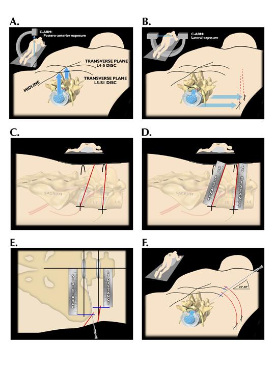 微创手术治疗腰椎间盘突出成功率,目前最热门腰椎微创技术椎间孔镜