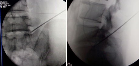 微创手术治疗腰椎间盘突出成功率,目前最热门腰椎微创技术椎间孔镜