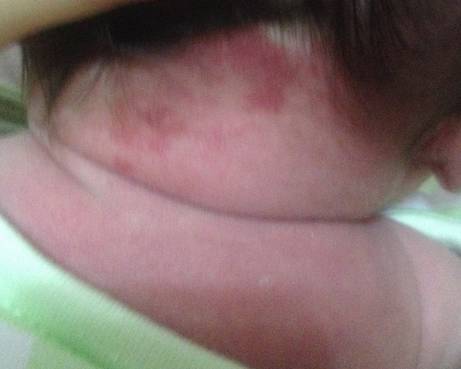 宝宝身上有哪些胎记,有胎记的小孩儿是不是天使