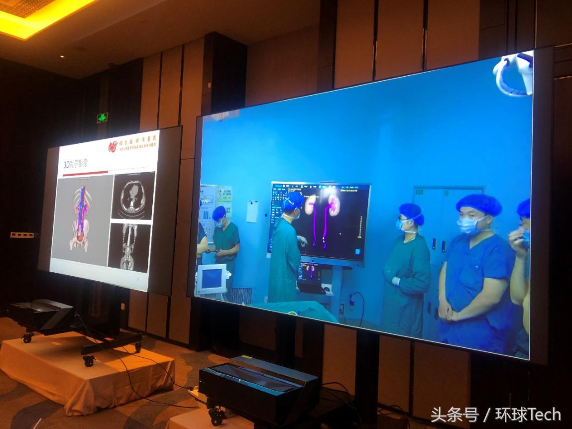 山东省立医院肾结石微创,肾结石3.2厘米微创手术