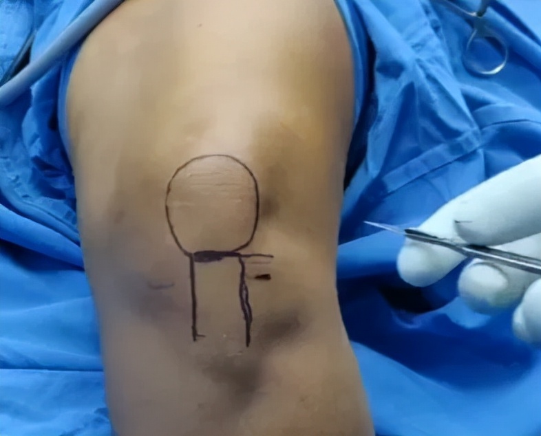 关节镜的适应症是什么,关节镜操作流程及注意事项