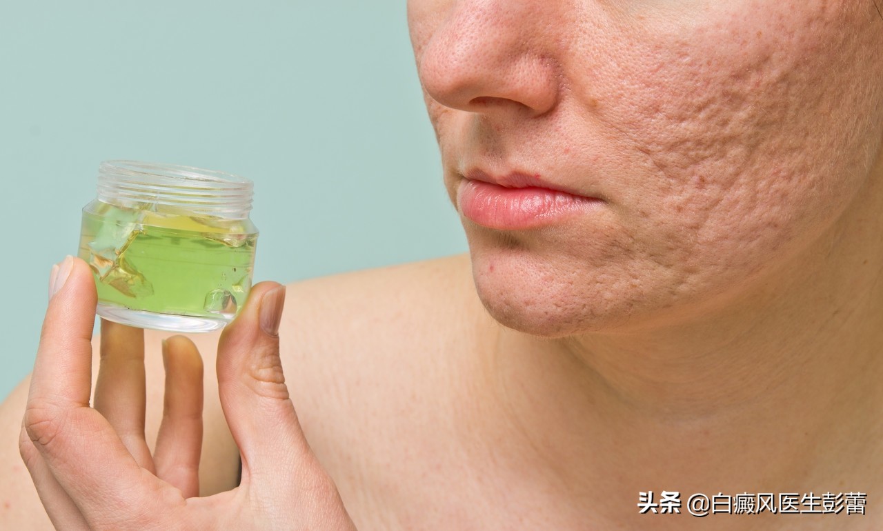 治疗白癜风的激素类药膏,儿童白癜风可以用激素类药物吗