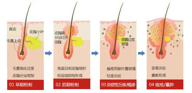 大油皮的坏处是什么,大油皮为啥还起皮