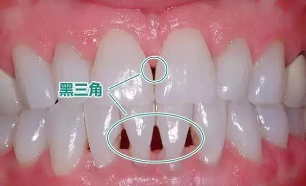 牙齿黑三角区怎么办,牙齿黑三角怎么改善