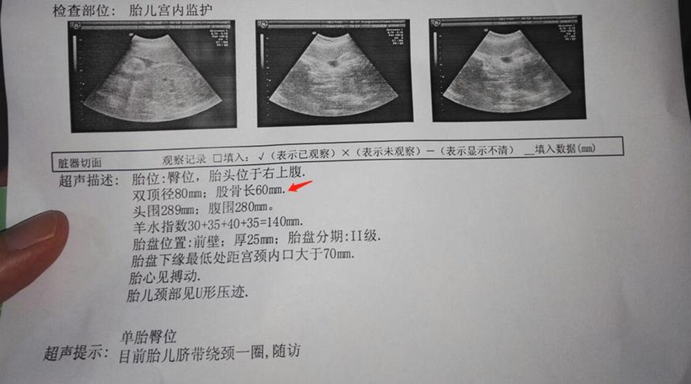 产检胎儿头大腿短是什么原因,产检胎儿腿短求解答