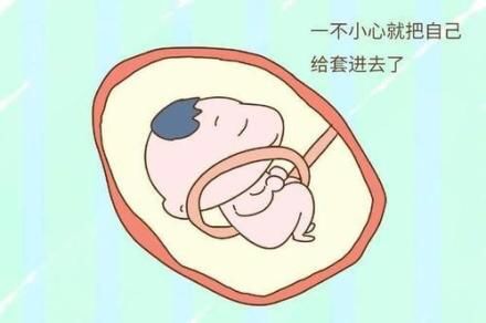 胎儿脐带绕颈有什么症状,胎儿脐带绕颈的症状有哪些