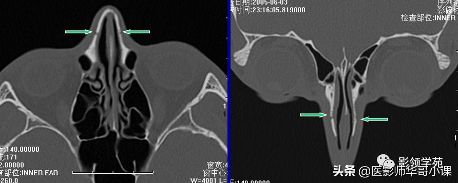 「鼻骨彩图」鼻骨CT解剖及骨折影像学诊断