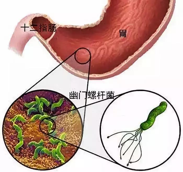 胶囊胃镜再也不用忍受插管的痛苦,插管胃镜和无痛胃镜哪种最好