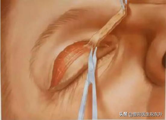 眼皮老是耷拉着睡不醒？恢复年轻其实并不难！