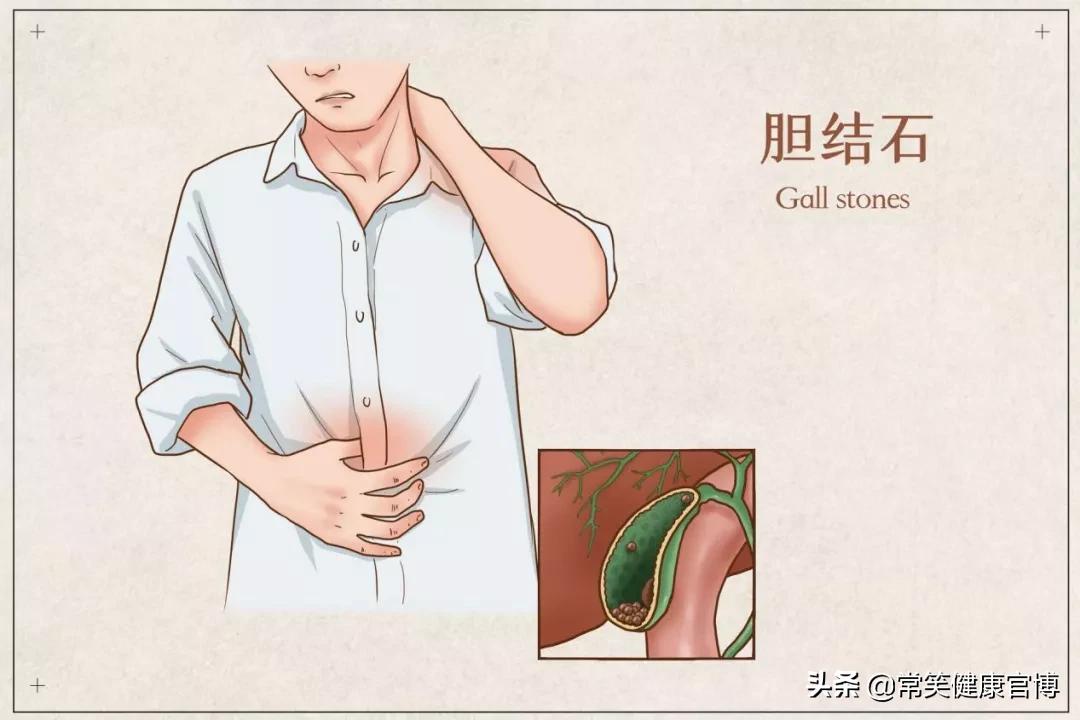 患过胆结石的人能吃螃蟹吗,男子吃多螃蟹竟引发如此悲剧