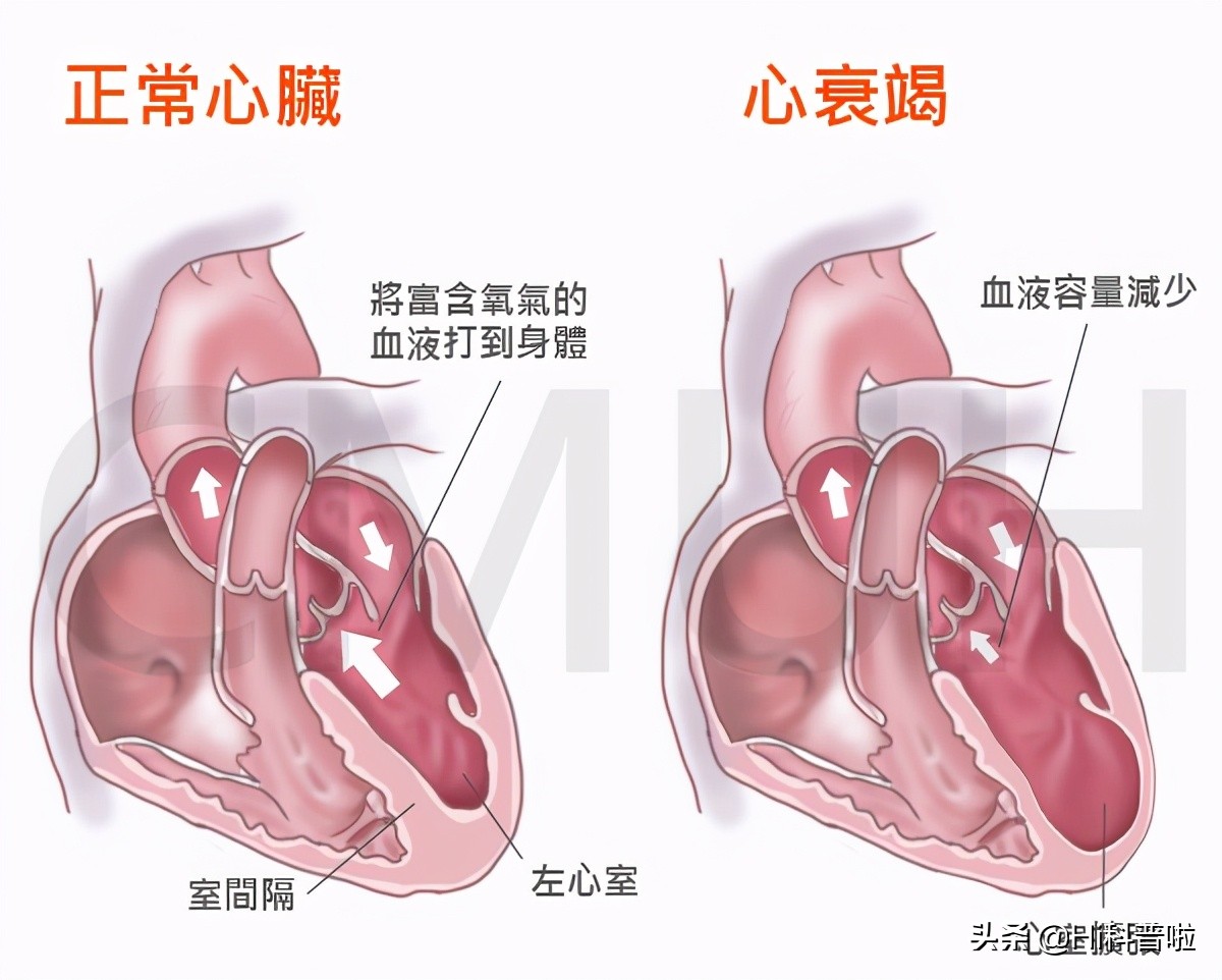 第四代磁悬浮人工心室人民日报,中国成功研制出磁悬浮心室了吗
